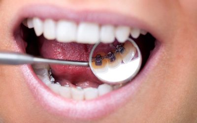 Intérêts d&rsquo;un traitement orthodontique