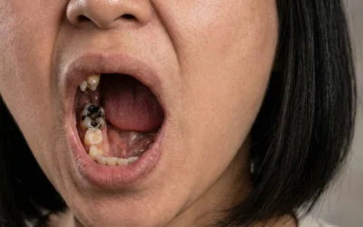 Couronne dentaire à Paris : types, conseils et prix