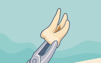 Extraction dentaire à Paris : choisir le bon praticien