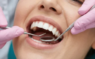 Détartrage à Paris : tout savoir sur ce soin essentiel