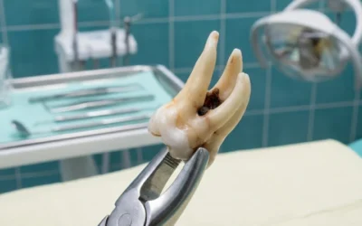 Extraction dentaire à Paris : choisir le bon praticien