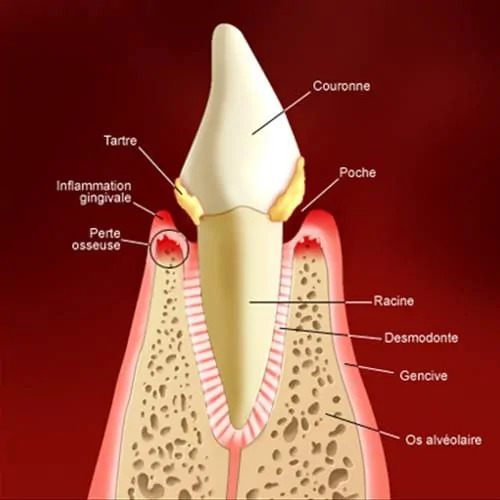 etape parodontite gingivite