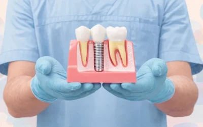 Combien de séances pour un implant dentaire ?