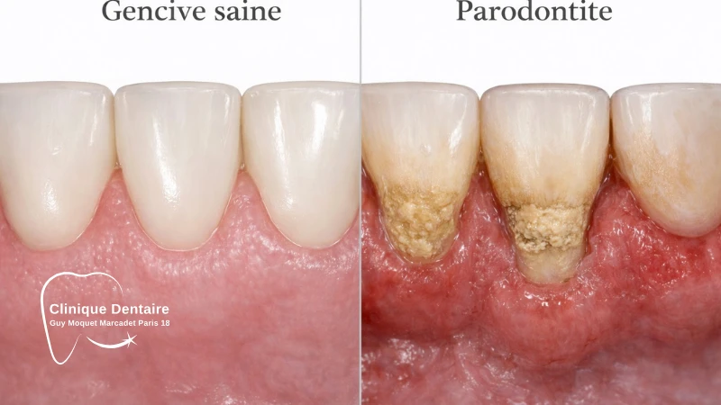 Dechaussement dent image