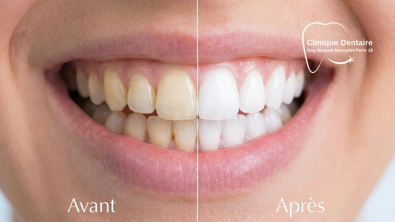 blanchiment dent avant apres