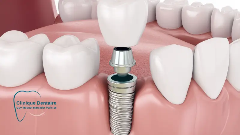 implant dent tabac