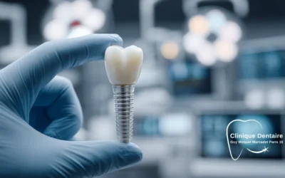 Implants dentaires Euroteknika : la précision française au service de votre sourire