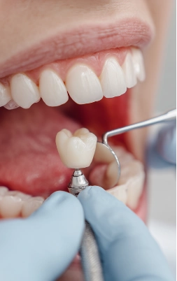 pose implant dent