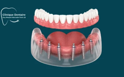 Combien d&rsquo;implants dentaires peut-on poser en une seule fois ?