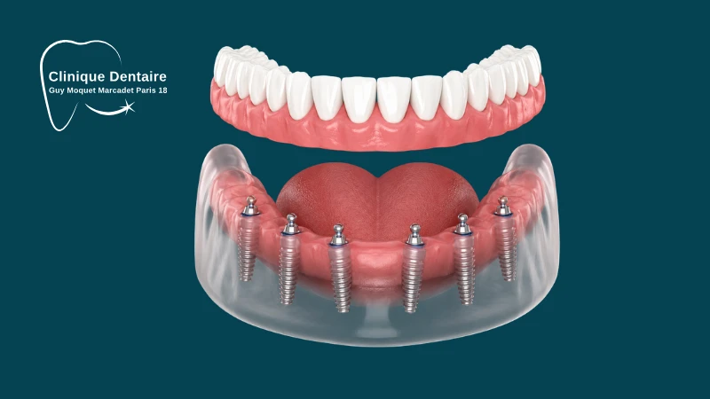 combien implant une seance
