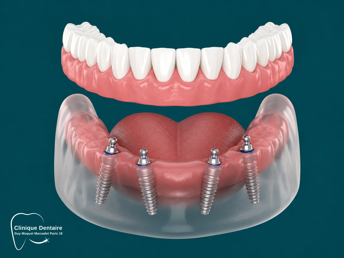 All on 4 Implants dentaires Paris All on 4 Implants dentaires Paris