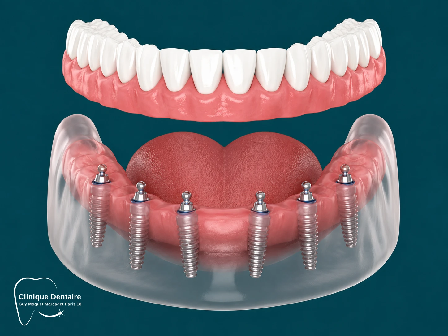 All on 6 Implants dentaires Paris.webp All on 6 Implants dentaires Paris.webp