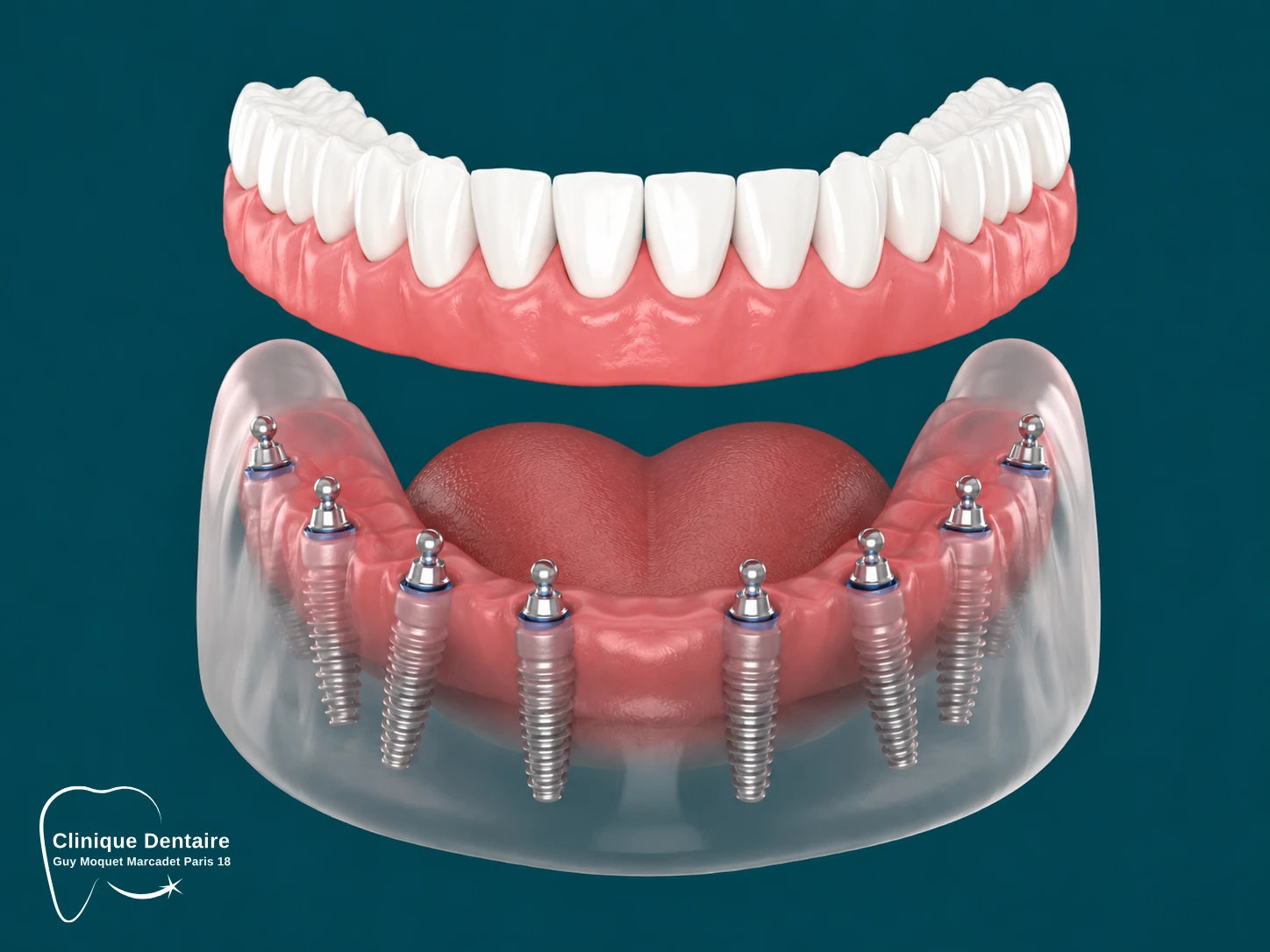 All on 8 Implants dentaires Paris.webp All on 8 Implants dentaires Paris.webp